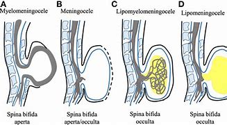 Image result for Spina Bifida with Meningocele