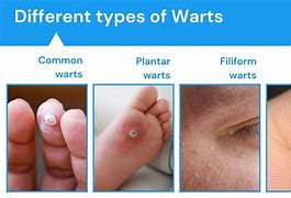 Image result for Wart Pictures On Body