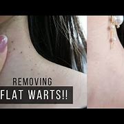 Image result for Chest Warts