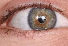 Image result for Eyelid Margin Papilloma