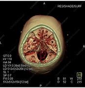 Image result for Circle of Willis 3D CT