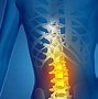 Image result for T11 T12 Spinal Cord Injury