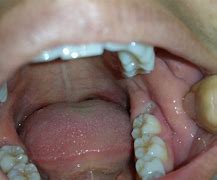Image result for Wisdom Teeth Growing Sideways