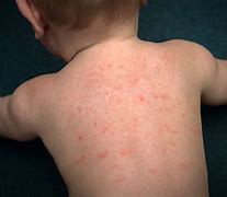 Image result for Baby Formula Allergy Rash