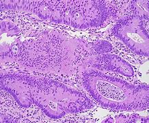 Image result for Sinonasal Cancer Pictures