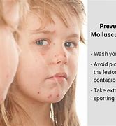 Image result for How to Get Rid of Molluscum Naturally