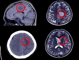 Image result for Tac Cerebral