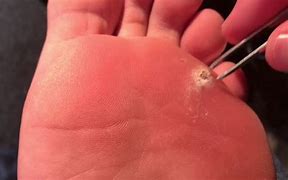 Image result for Wart Removers That Work