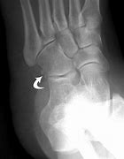 Image result for OS Peroneum Feet