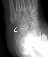 Image result for OS Peroneum Fracture