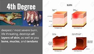 Image result for 3rd 4th Degree Burns