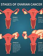Image result for Ovarian Cancer Stages