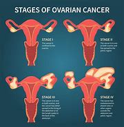 Image result for Staging of Ovarian Cancer