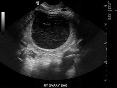Image result for Cyst On Ovarian Cancer Ultrasound