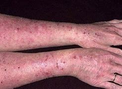 Image result for Adult Eczema On Arms