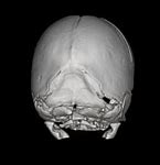 Image result for Mercedes-Benz Craniosynostosis