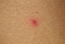 Image result for Folliculitis On Thighs