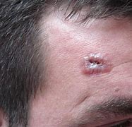 Image result for Untreated Basal Cell Carcinoma