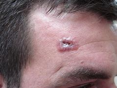 Image result for Basal Cell Carcinoma Telangiectasia