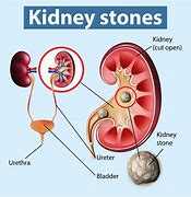 Image result for Left Kidney Stone
