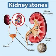 Image result for Male Kidney Stones
