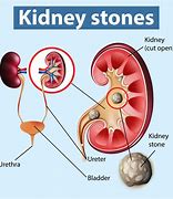 Image result for What Does a Kidney Stone Look Like 2Mm
