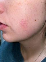 Image result for Dry Skin Bumps On Face
