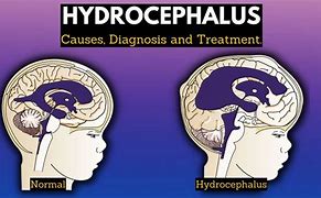Image result for Signs of Hydrocephalus 7 Month Old Baby