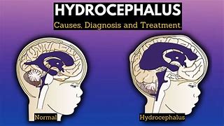 Image result for Hydrocephalus Signs and Symptoms
