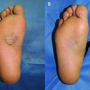 Image result for actinomidosis