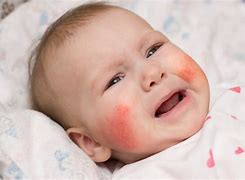 Image result for Infant Allergy