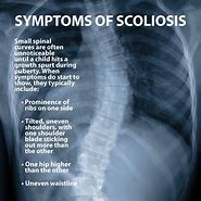 Image result for R Scoliosis