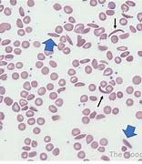 Image result for Sickle Cell Blood Smear