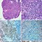 Image result for Small Cell Lung Cancer Types