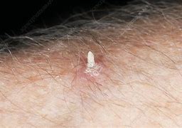 Image result for Cutaneous Horn Wart