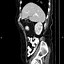 Image result for Radiopaedia Apple Core Sign