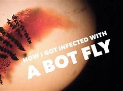 Image result for Human Bot Fly Infection