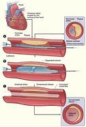 Image result for Coronary Angiography Procedure