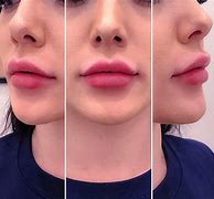 Image result for Botox Lips Pictures