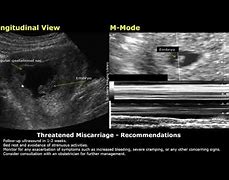 Image result for Miscarriage Ultrasound Radiology