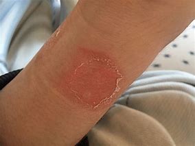 Image result for Apple Watch Burning Wrist