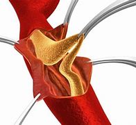 Image result for Carotid Artery Stenosis Surgery