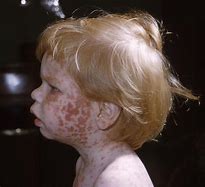 Image result for Rubeola vs Measles Symptoms