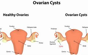 Image result for Pain From Ovarian Cyst