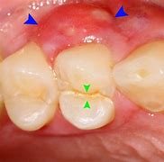 Image result for Gingival Abscess