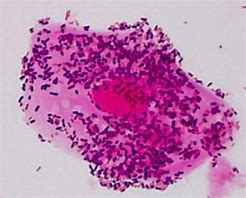 Image result for Gardnerella Vaginalis Clue Cells