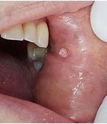Image result for Papilloma On Buccal Gingival