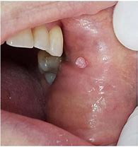 Image result for Squamous Papilloma Soft Palate Contagious