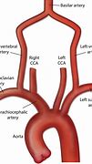 Image result for Vertebral Artery Triangle