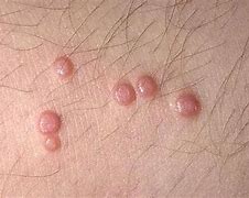Image result for Images of Molluscum